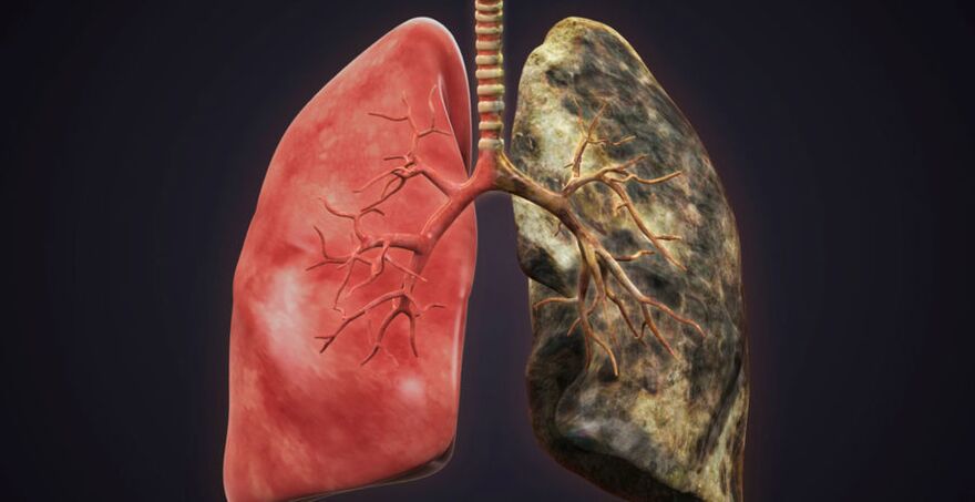 pulmón de fumador y pulmón para dejar de fumar