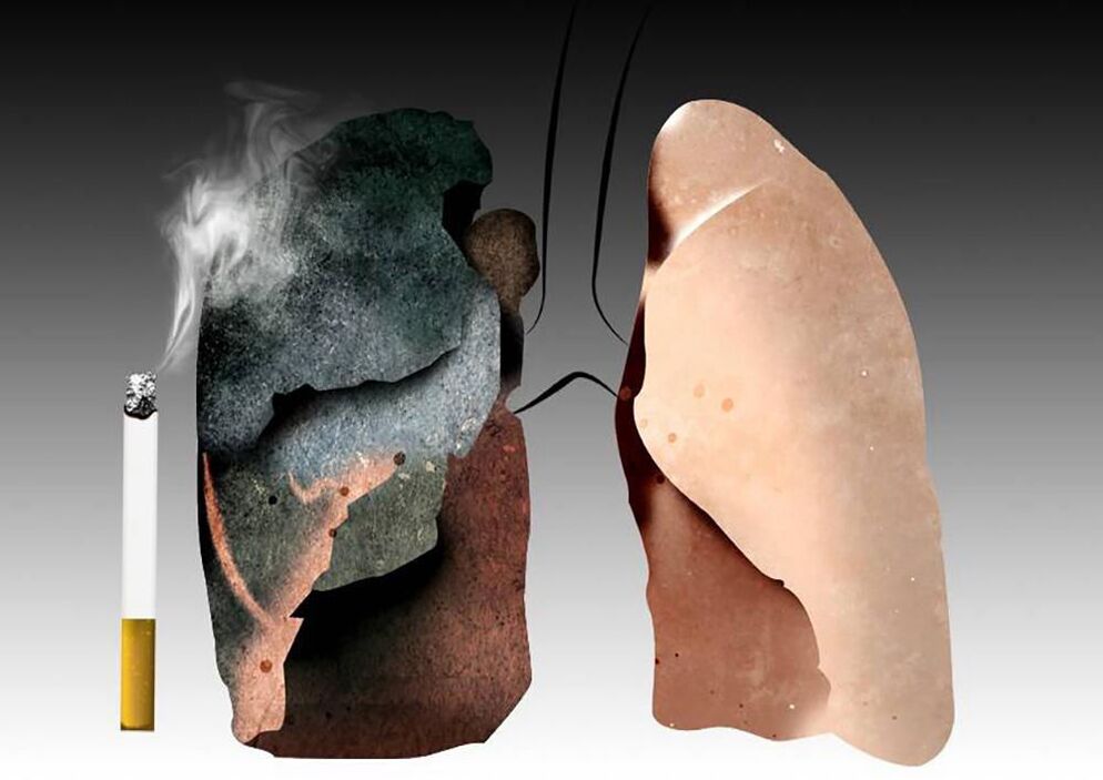 pulmones de un fumador